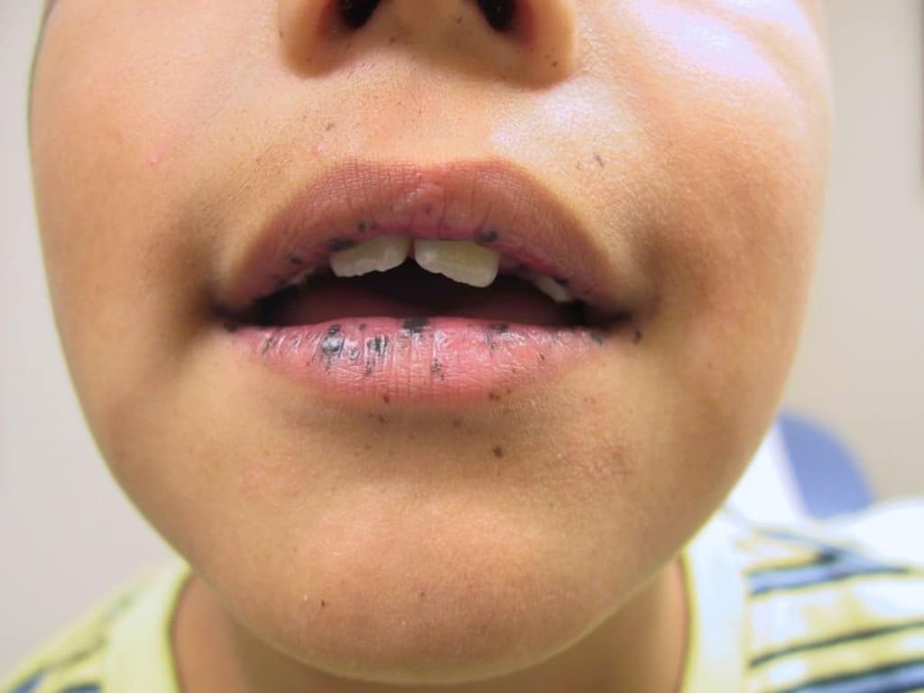 lip diseases