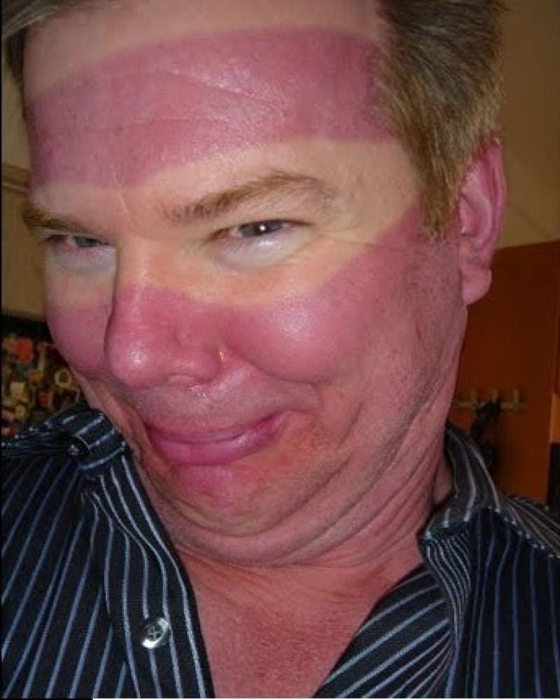 Bilderesultat for worst sunburn
