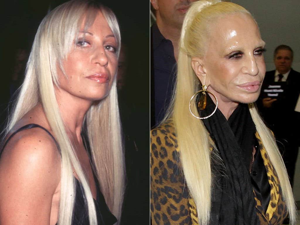 20 Worst Cases Of Celebrity Plastic Surgery Gone Wrong