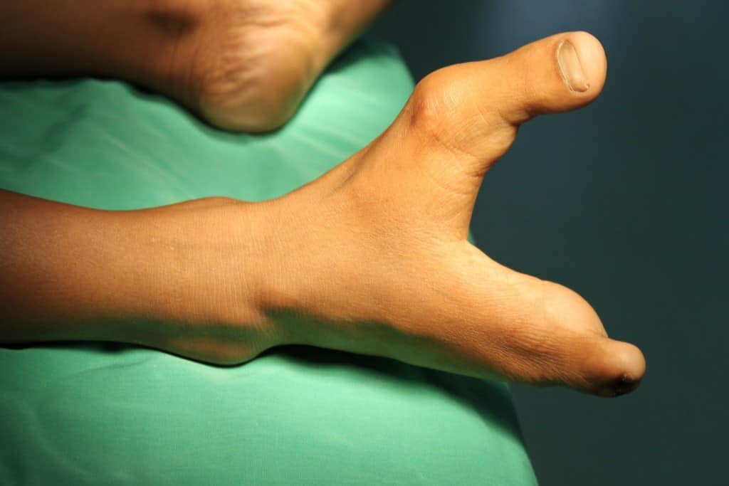 20 of the Most Shocking Physical Mutations - Page 2 of 5