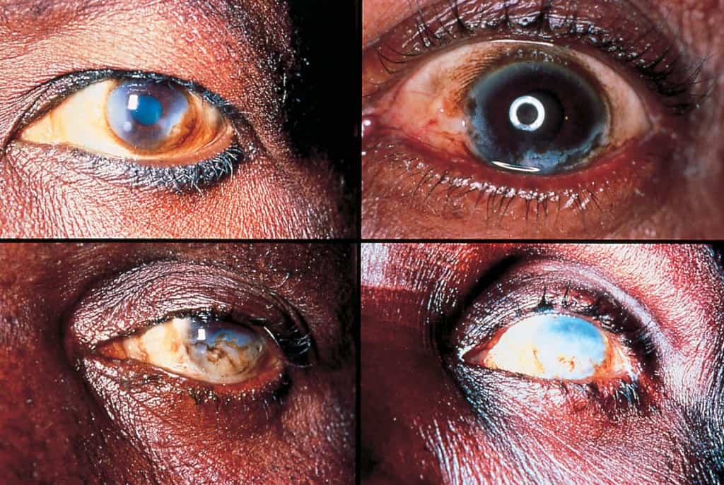 Onchocerciasis
