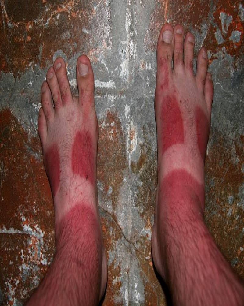 Bilderesultat for worst sunburn